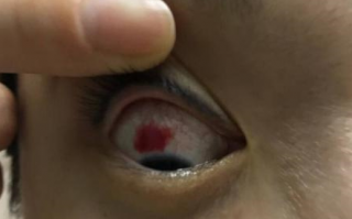 美瞳戴眼睛红怎么办，带美瞳带的眼睛红怎么办