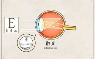 如何矫正散光，如何矫正散光自然恢复