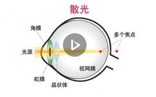 怎么知道是不是散光眼，怎么知道是不是散光眼呢